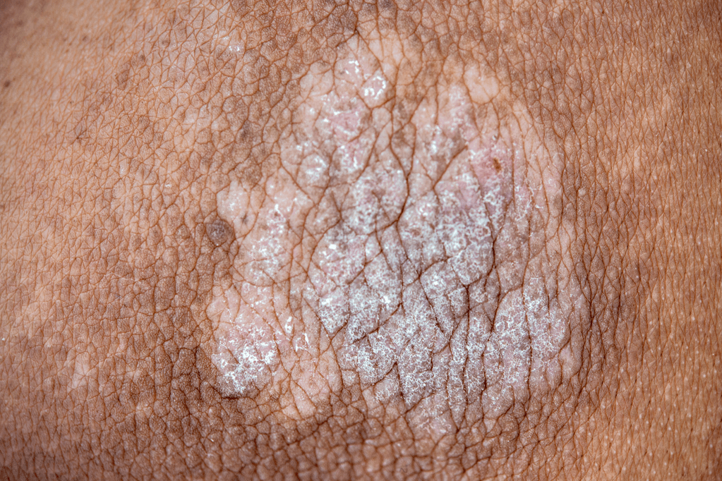 Patch of Plaque Psoriasis